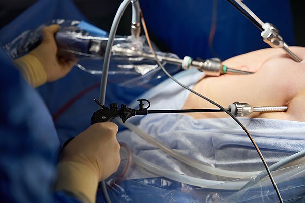 Laparoscopic Surgeries
